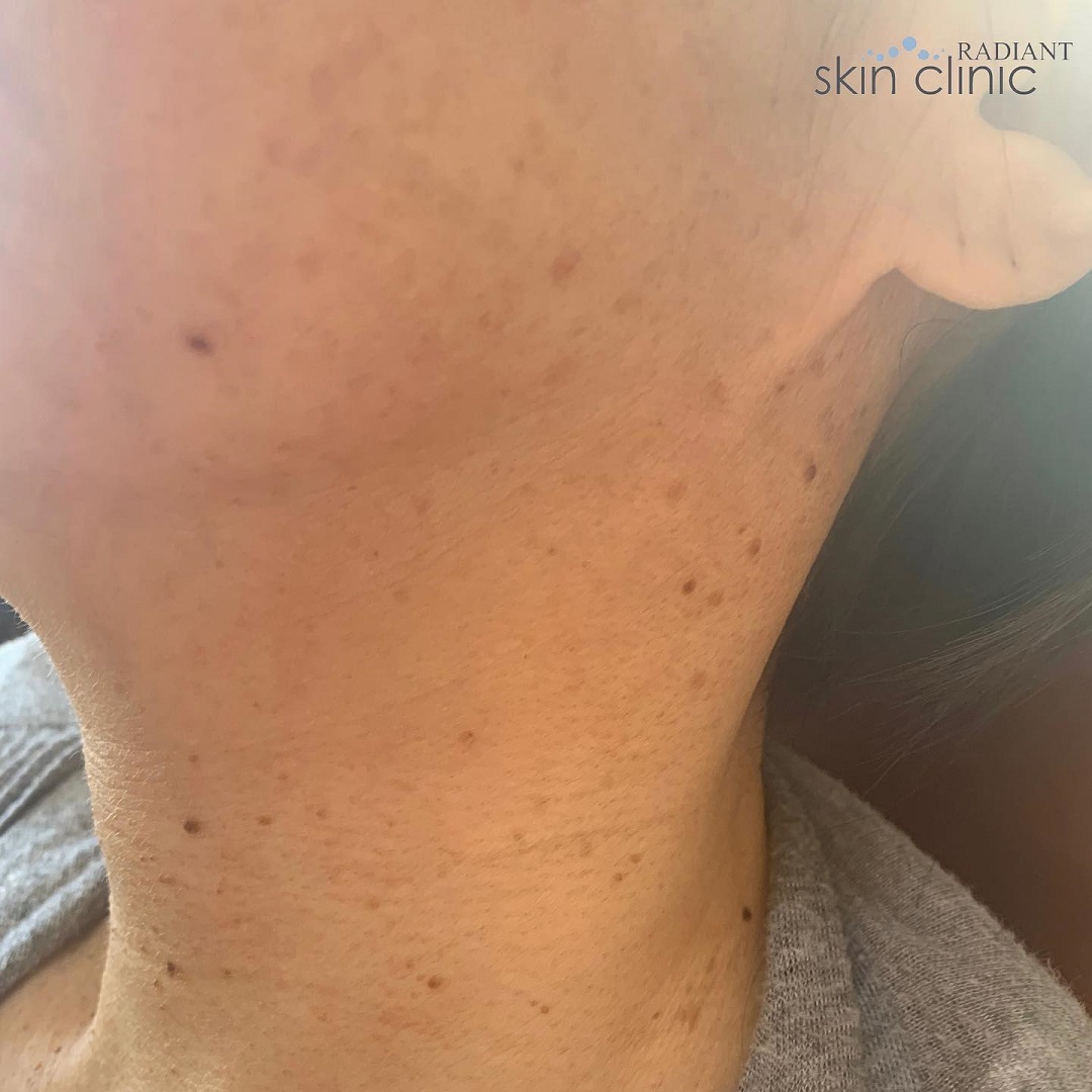 Lamprobe - Skin Tags Radiant resized
