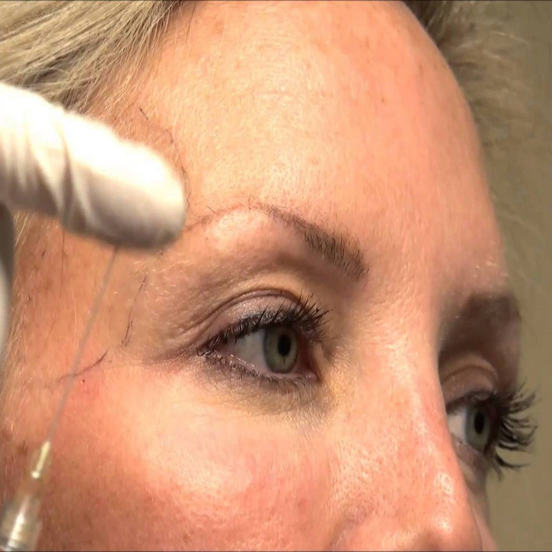 dermal-filler-for-temples